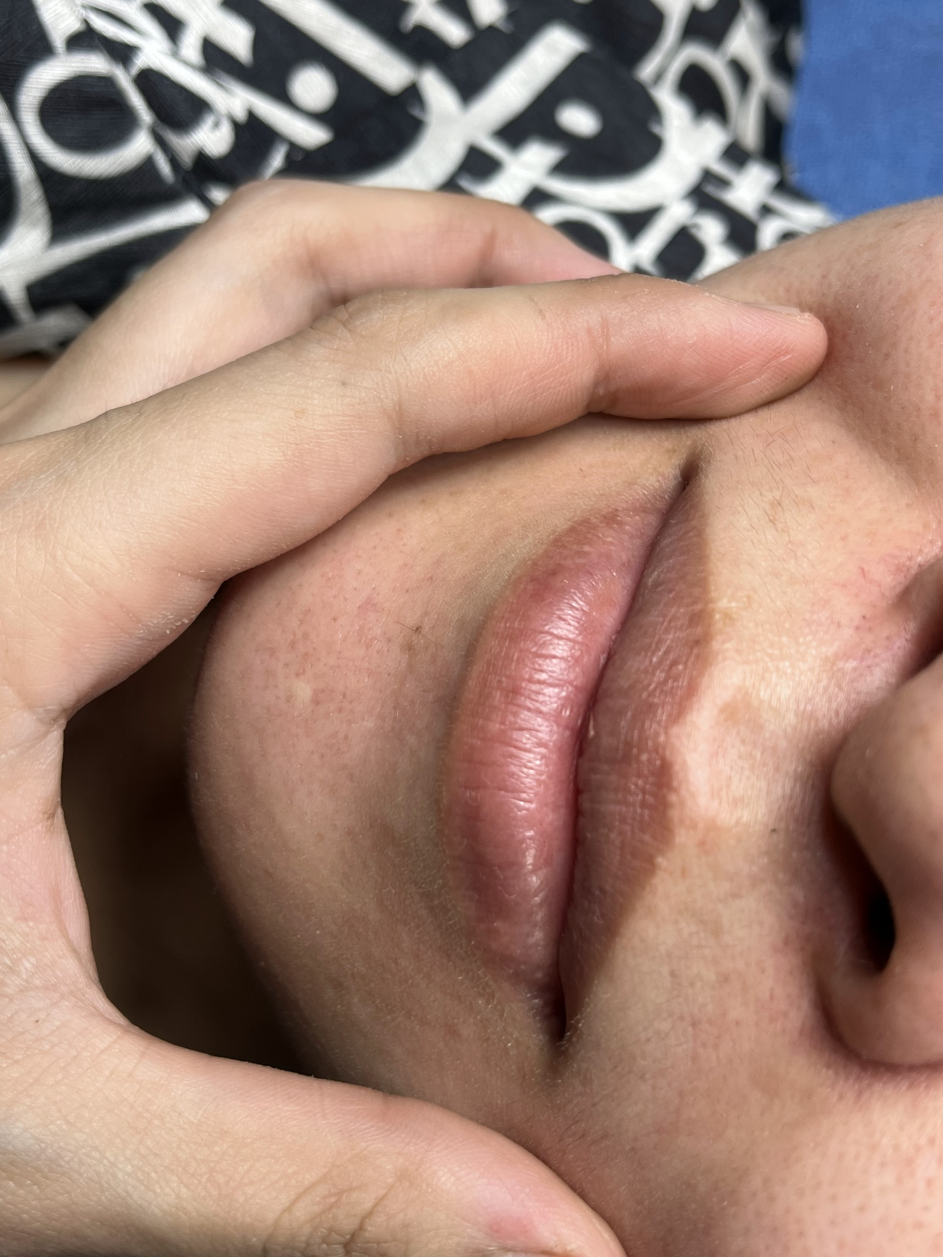 trị khử thâm môi