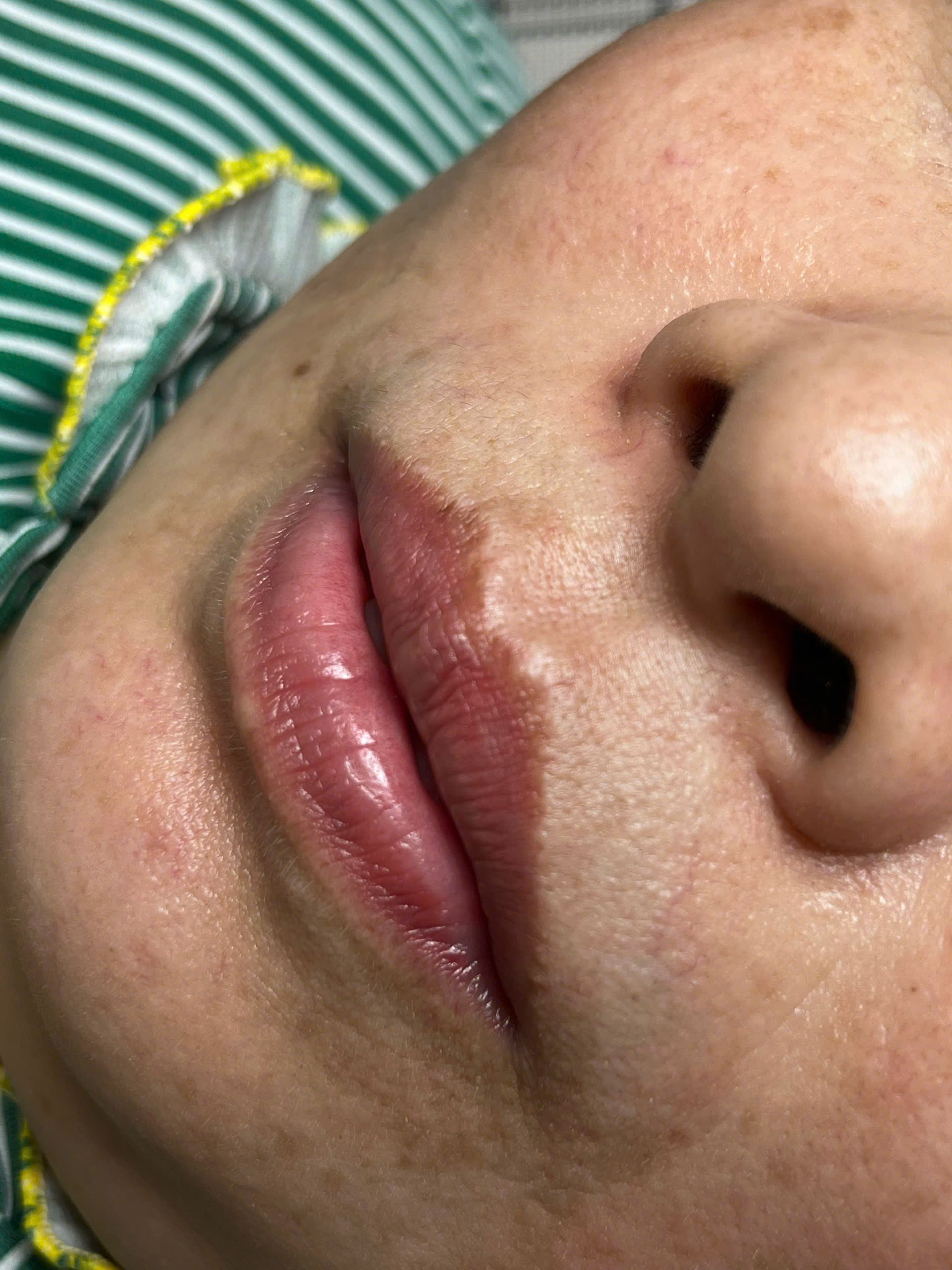 Phun xăm môi Collagen